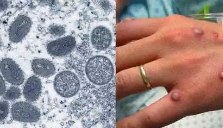 Mato Grosso do Sul tem primeiro caso suspeito da varíola dos macacos
