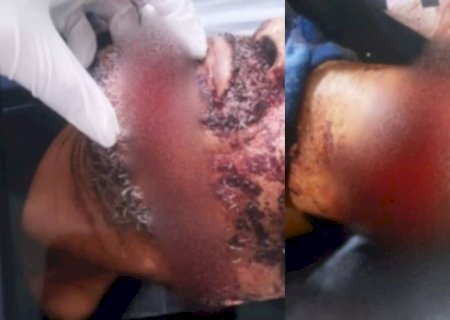 Morre homem que teve mão decepada após briga com a companheira